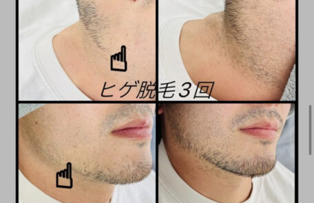 【メンズ】ヒゲ脱毛を3回施術した豊川市のお客様のお写真